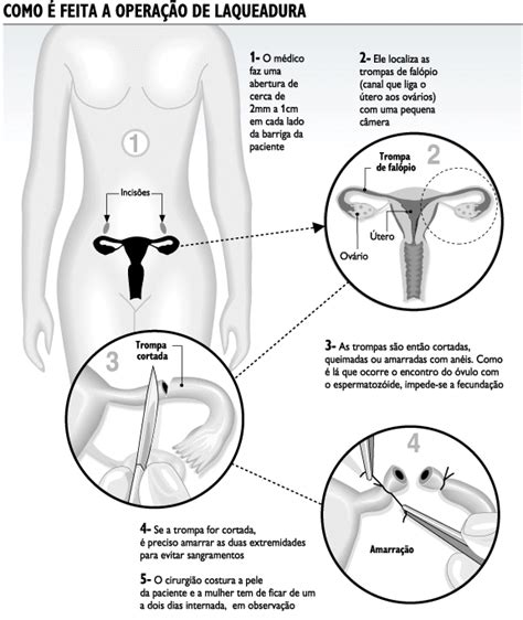 Poderosas Falando Sério: Métodos contraceptivos: Cirúrgicos... 