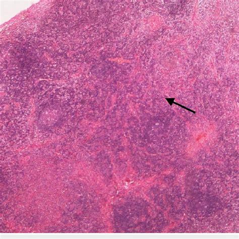 X100 Magnification Using Hematoxylin And Eosin Stain Hande Which Shows