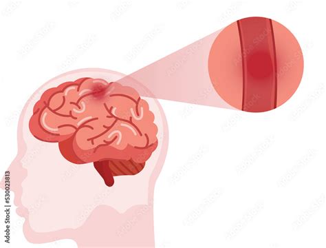 Stroke Disease Hemorrhagic Brain Stroke Concept Apoplexy Cerebral Hemorrhage Headache