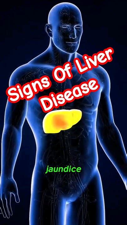 Liver Disease Warning Signs Liver Disease Symptoms Liver Damage Acute Liver Failure Youtube