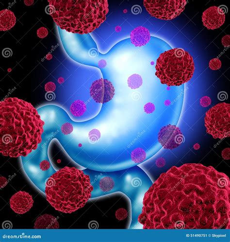 Stomach Cancer Stock Illustration Image 51490751