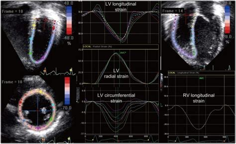 Two Dimensional Speckle Tracking Echocardiography Demonstrating The