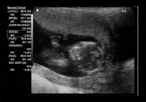 Fetus ultrasound — Stock Photo © Tsekhmister #4594485