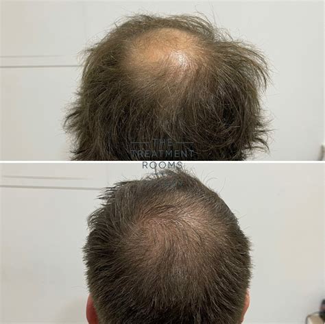 Balding Crown And Crown Hair Transplant Treatment Rooms London