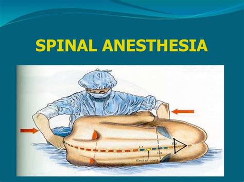 Spinal Anesthesia Ppt