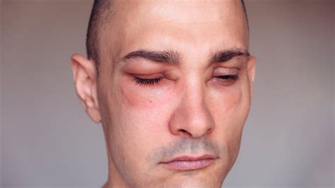 disease  swelling   face infoupdateorg