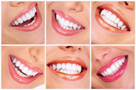 New Smile Dental: Brighten Your Smile with Teeth Whitening from Dr. Lopez