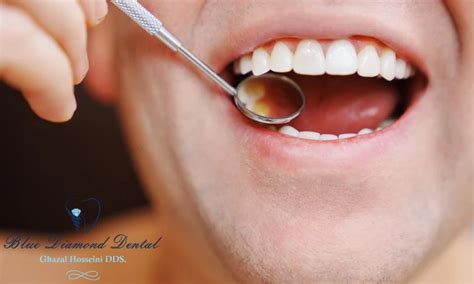 How To Fix A Chipped Tooth At Home Blue Diamond Dental