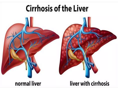 Liver Cirrhosis Ppt