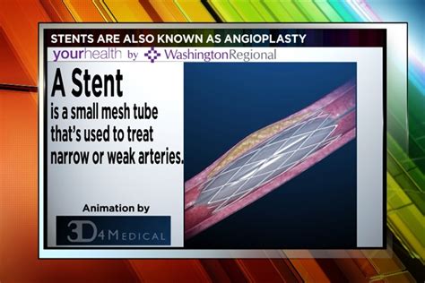 Stents What You Need To Know Before Surgery