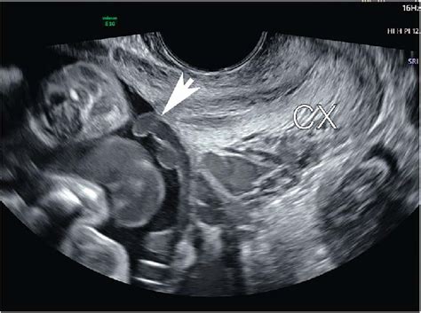 Gray Scale Transvaginal Ultrasonogram Showing Hypoechoic Linear And