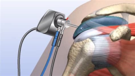 Subacromial Impingement Dr Chakradhar