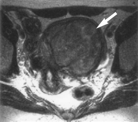 Uterine Leiomyomas Histopathologic Features Mr Imaging Findings Differential Diagnosis And