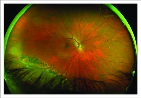 A localized inferotemporal retinal dialysis that was treated by laser ...