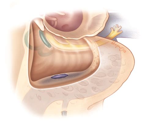 Complications of Mastoidectomy – Oto Surgery Atlas