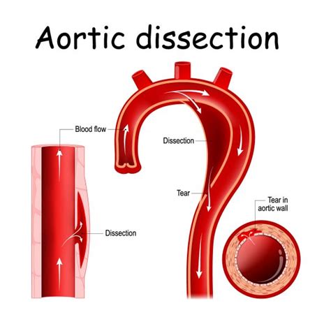 Aortic Dissection Risks And 8 Critical Symptoms Vejthani