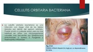 Celulitis Orbitaria PPT