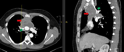 Superior Vena Cava Syndrome Hematology Org