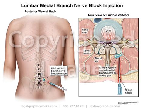 Lumbar Medial Branch Nerve Block Injection - Legal Graphicworks