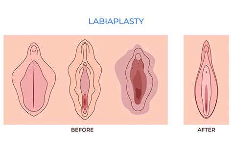 Un Enemigo Oculto Entre Tus Piernas La Hipertrofia Vaginal