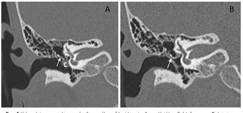 Figure From Transcanal Endoscopic Ear Surgery For Congenital