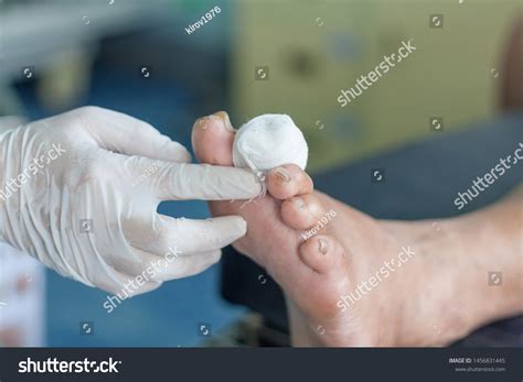 Infected Wound Diabetic Foot Stock Photo 1456831445 Shutterstock