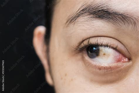 A Woman With Brown Spot On Her Sclera Diagnosed As Hemorrhagic