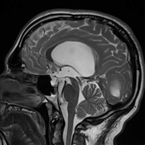 Cystic Acoustic Schwannoma Image Radiopaedia Org