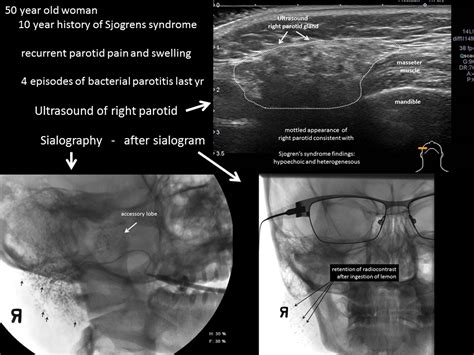 Ultrasound And Sialogram Of Right Parotid Sjogrens Syndrome Iowa Head And Neck Protocols