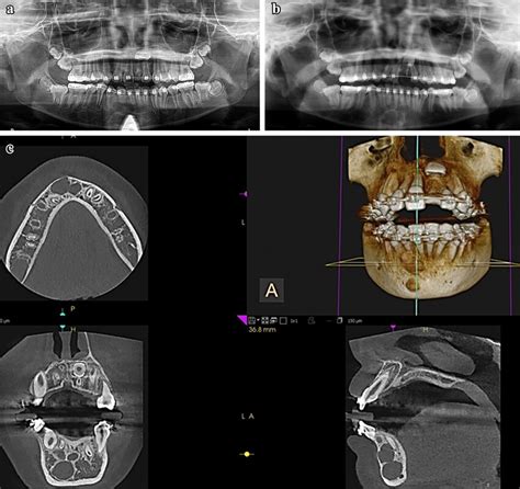 A Panoramic Radiograph At Initial Presentation Showing A Multilocular