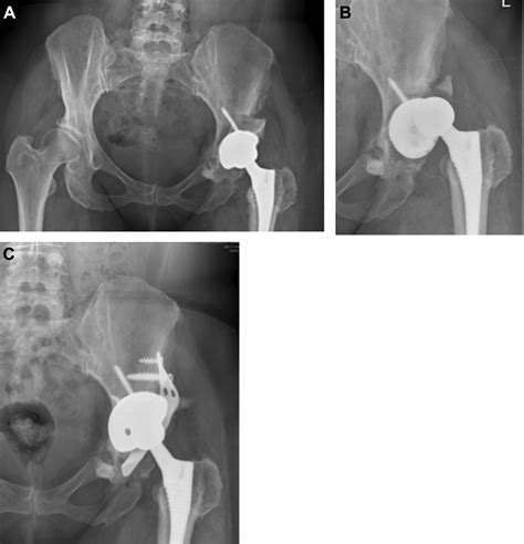 The Direct Anterior Approach For Complex Primary Total Hip Arthroplasty The Extensile