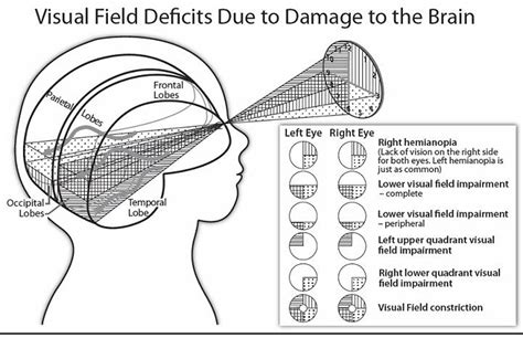 Frontiers Impact Of Cerebral Visual Impairments On Motor Skills