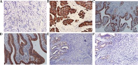 Figure 1 From Rescued Expression Of WIF 1 In Gallbladder Cancer