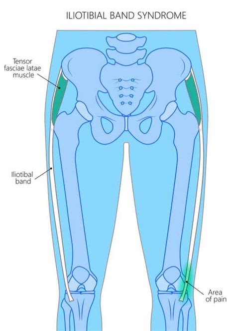 Iliotibial Band Tenodesis ACL Surgery ITB Tenodesis Orthopedic