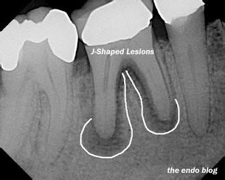 ashtrdentist: vertical root fracture