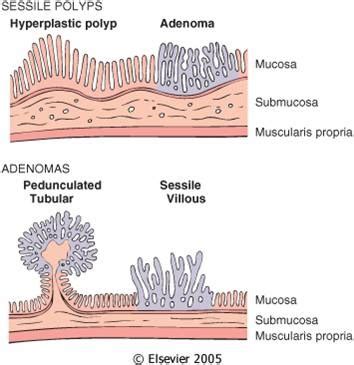 Sessile Polyp