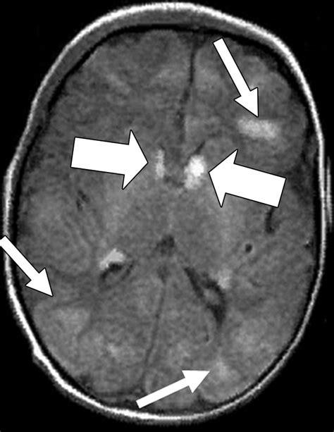 Comprehensive Imaging Manifestations Of Tuberous Sclerosis Ajr