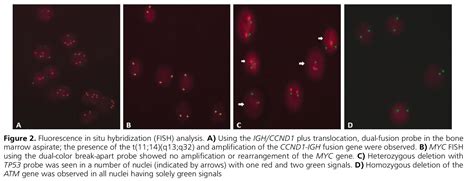 Blastoid Variant Mantle Cell Lymphoma With Amplified IGH CCND1 Fusion