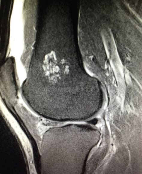 Larme De Meniscal Genou Irm Photo Stock Image Du Anatomie Ligament