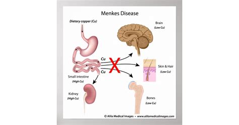 Menkes syndrome, labeled diagram. poster | Zazzle