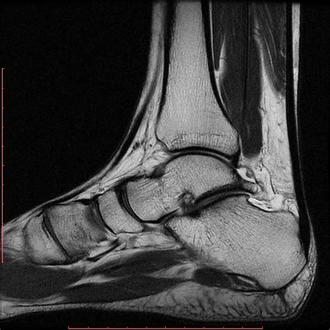 Posterior Ankle Impingement Image