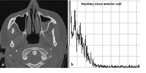 Figure 1 From A Mode Ultrasound In The Diagnosis Of Maxillary Sinusitis