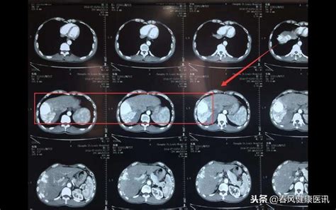 早期肺癌信號怎麼查？醫生說最好定期做肺部ct檢查 每日頭條