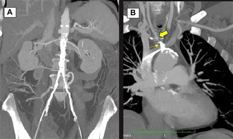 Ascending Aortobifemoral And Adjunct Carotid Bypass Grafts Journal Of Vascular Surgery Cases