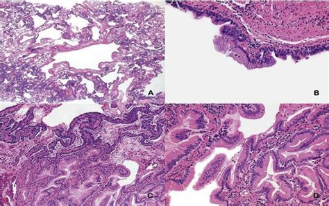 A Low Power View Shows A Large Predominant Cyst Characteristic Of