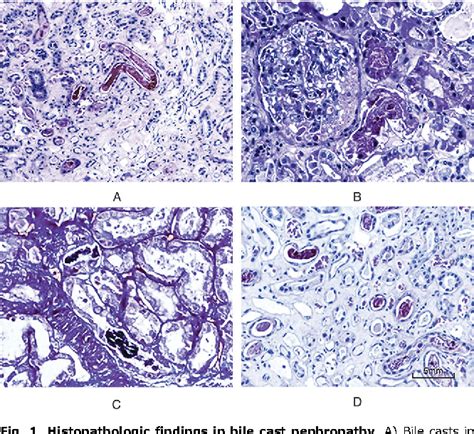 Figure From Bile Cast Nephropathy In Patients With Acute Kidney