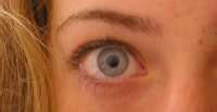 Eye migraines – symptoms of eye or silent migraine and what to do about ...