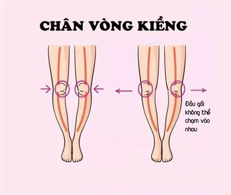 Exercises for people with bow legs | Vinmec