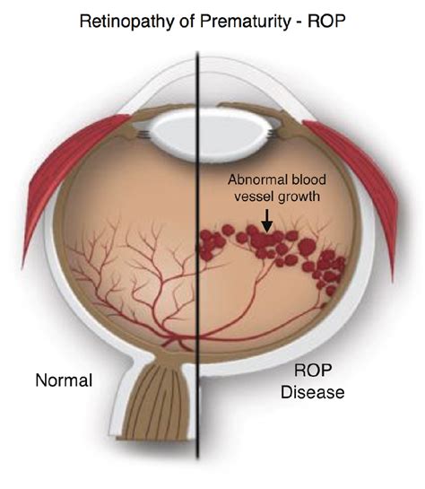 Retinopathy Of Prematurity Rop In Premature Infants