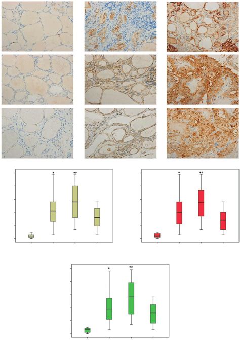 Expressions Of Pd L1 Pdk1 And P Akt Were Upregulated And Positively Download Scientific